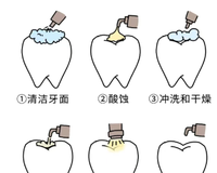 家长必看！儿童窝沟封闭那些事儿 窝沟封闭是什么？为什么要做？ 做窝沟封闭的最佳时间？疼不疼？