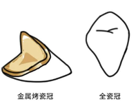 牙冠材质千千万，到底哪种更适合你？一次讲清！