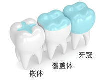 牙冠、嵌体、高嵌体、覆盖体分不清？一文讲透四种修复方式怎么选