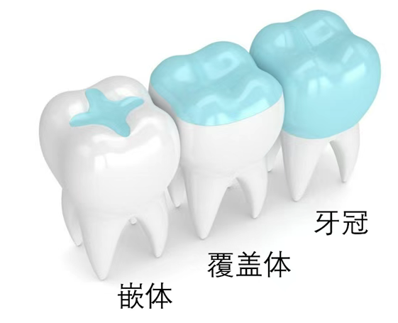 牙冠修复素材-种类